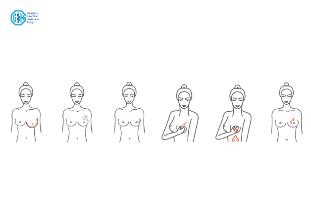 các triệu chứng ung thư vú giai đoạn đầu.png