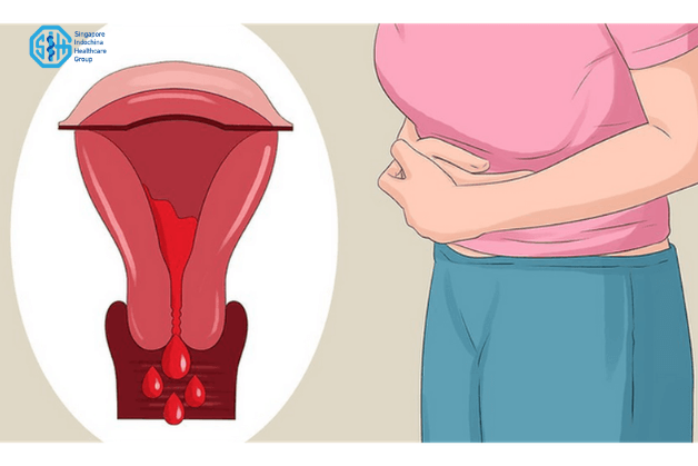 Hình minh họa chảy máu âm đạo bất thường ngoài kỳ kinh