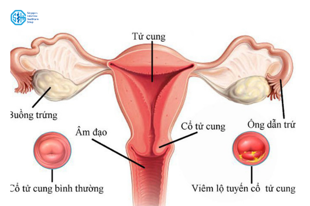 co-tu-cung-binh-thuong-va-viem-lo-tuyen.png