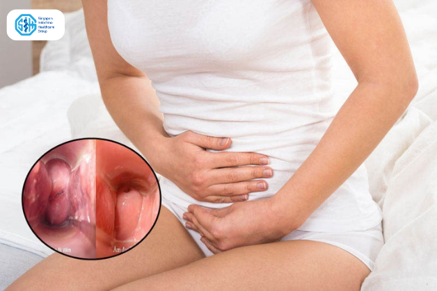 Viêm âm đạo cấp tính