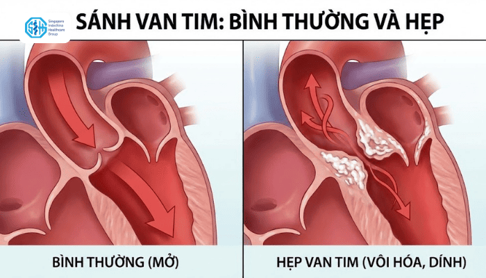 so-sanh-van-tim-binh-thuong-va-hep-van-tim.png