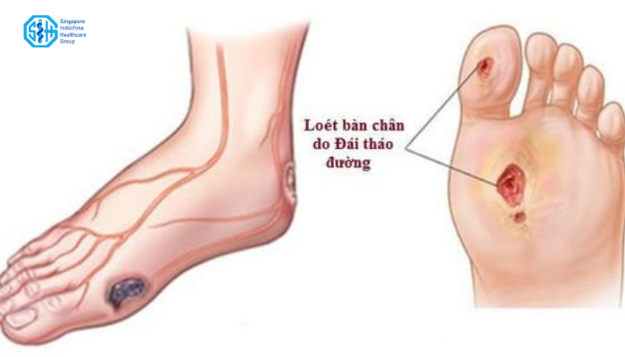 ban-chan-tieu-duong.png
