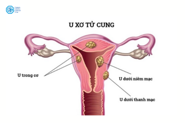 U xơ tử cung