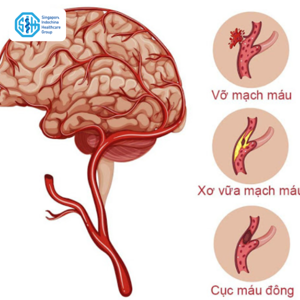 dấu hiệu cảnh báo đột quỵ