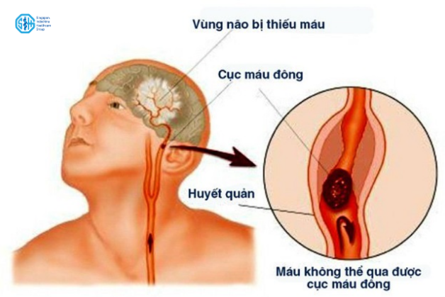 đột quỵ là gì