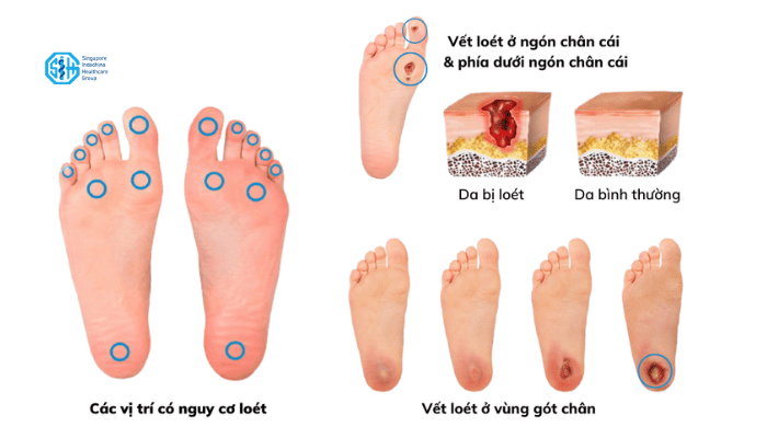 dau-hieu-ban-chan-tieu-duong.png