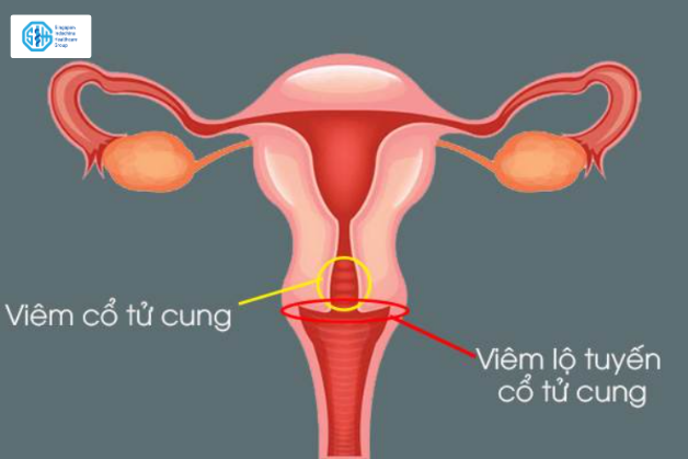 viem-lo-tuyen-co-tu-cung.png