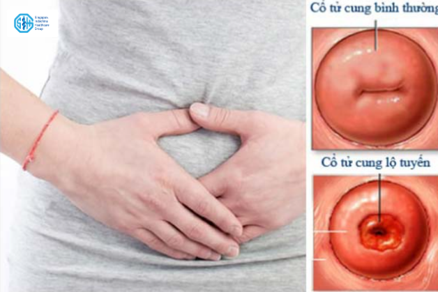 Viêm lộ tuyến cổ tử cung