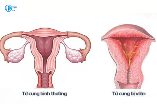 Viêm nội mạc tử cung