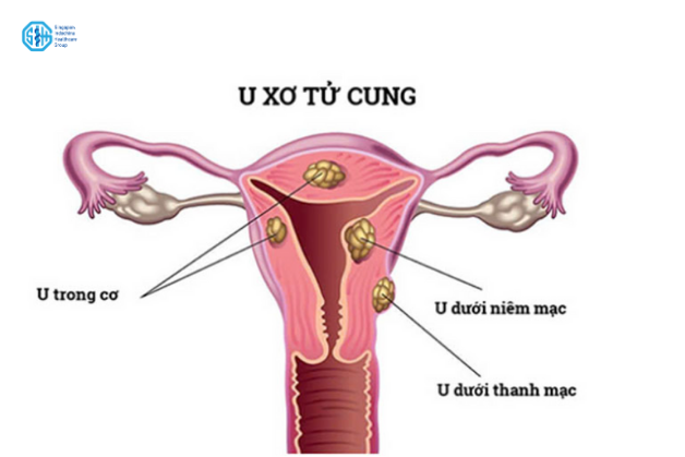 u-xo-tu-cung-kinh-nguyet-keo-dai.png