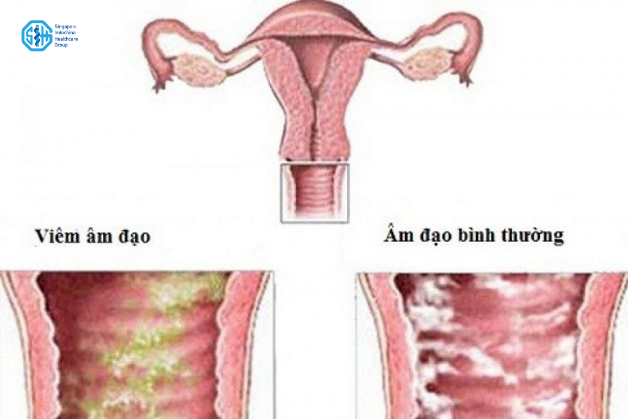 So sánh Âm đạo bị viêm và âm đạo bình thường