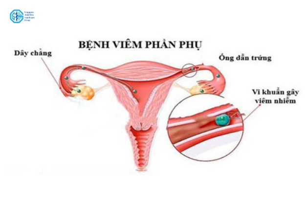 Hình minh họa nguyên nhân gây viêm phần phụ ở phụ nữ