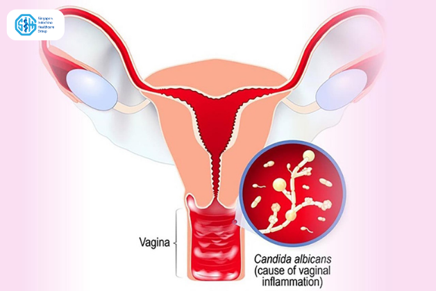 viem-am-dao-nam-candida.png