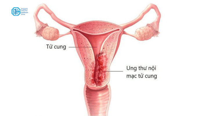 ung-thu-noi-mac-tu-cung.png