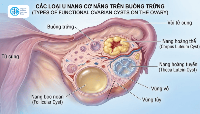 cac-loai-u-nang-thuc-the.png