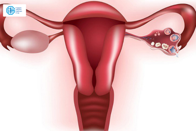  phụ nữ băn khoăn có nên quan hệ khi viêm phần phụ