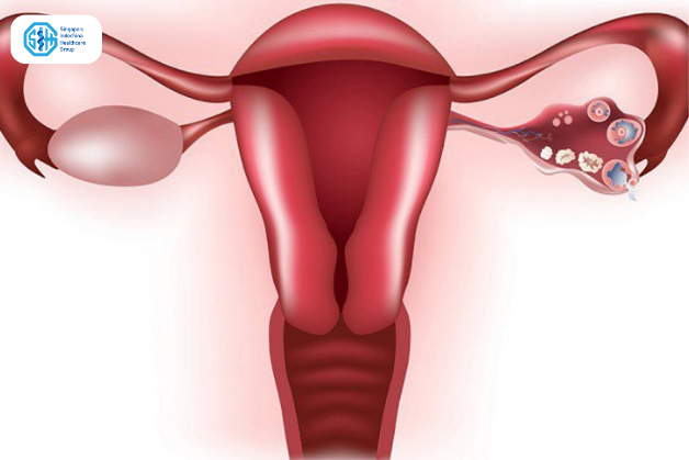 Pelvic Inflammatory Disease