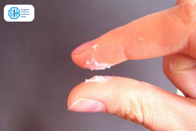 khí hư nấm Candida