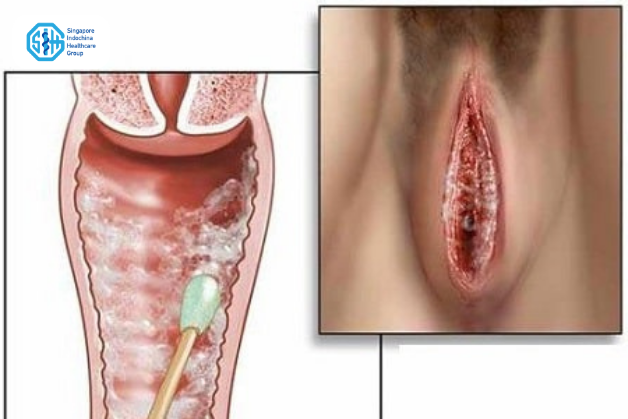 lấy mẫu soi tươi khí hư