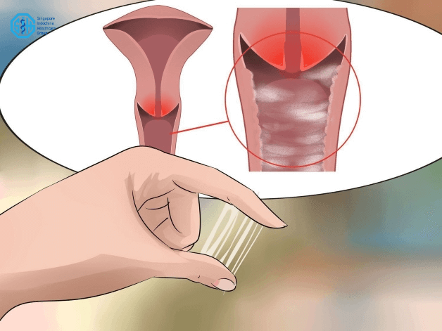 Viêm cổ tử cung và khí hư